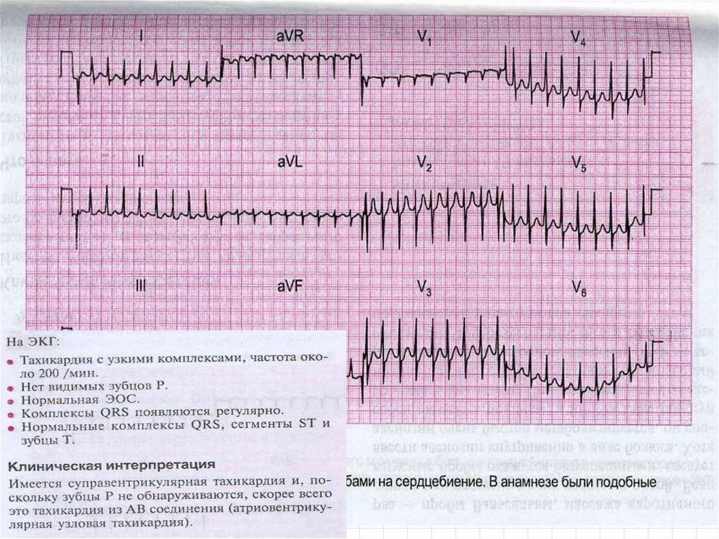 Регулярный ритм на ЭКГ. Сыркин ЭКГ для врача общей практики. Записи ЭКГ для практики. Большие квадраты на ЭКГ.