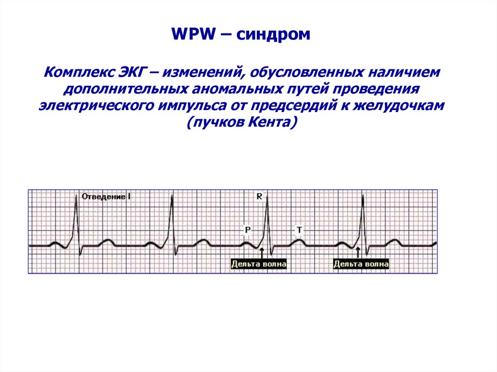 WPW – синдром Комплекс ЭКГ – изменений, обусловленных наличием дополнительных аномальных путей проведения электрического