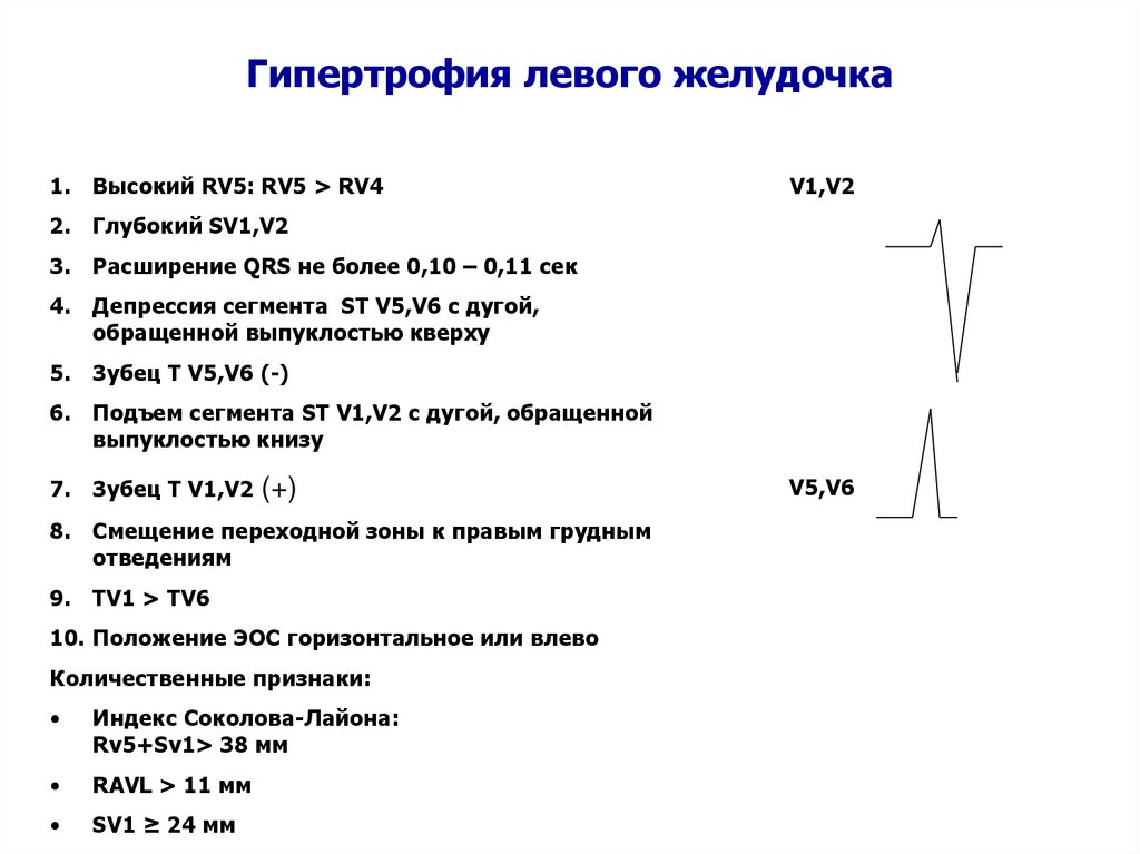 Левый желудочек на экг. Критерии гипертрофии левого желудочка на ЭКГ. ЭКГ гипертрофия левого желудочка заключение. Заключение ЭКГ при гипертрофии левого желудочка. Гипертрофия левого желудочка УЗИ критерии.