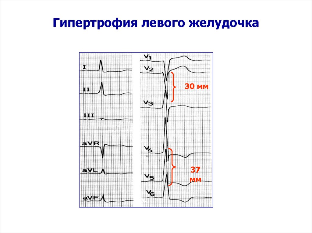 Косвенная глж