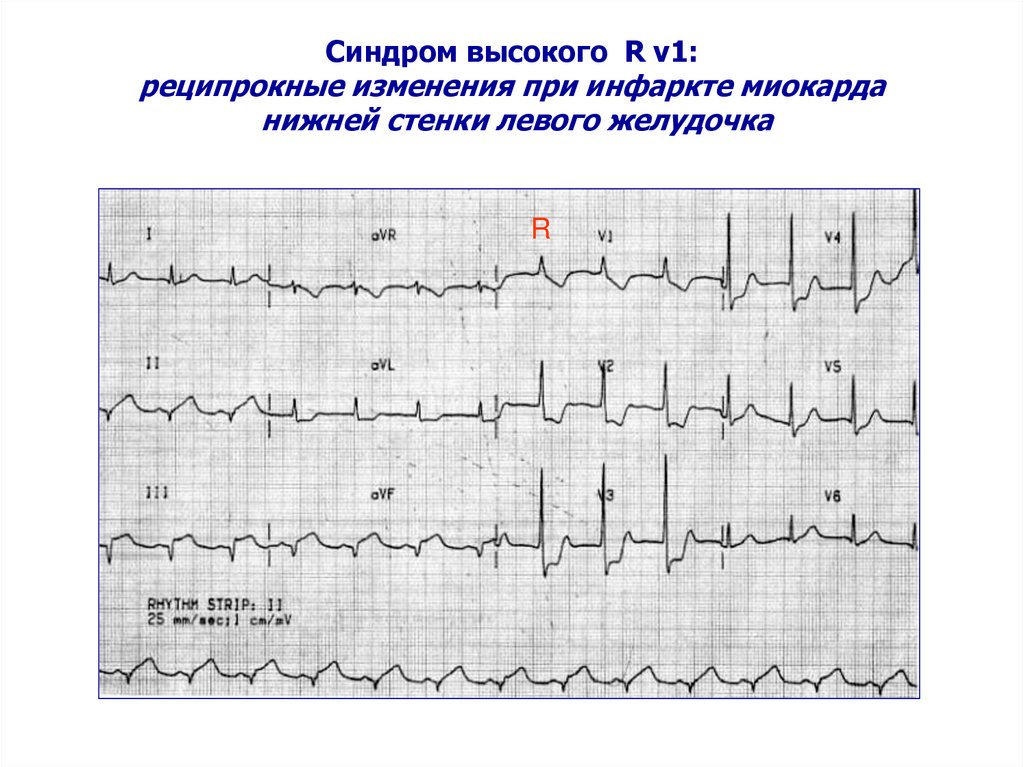 Очаговые изменения левого желудочка