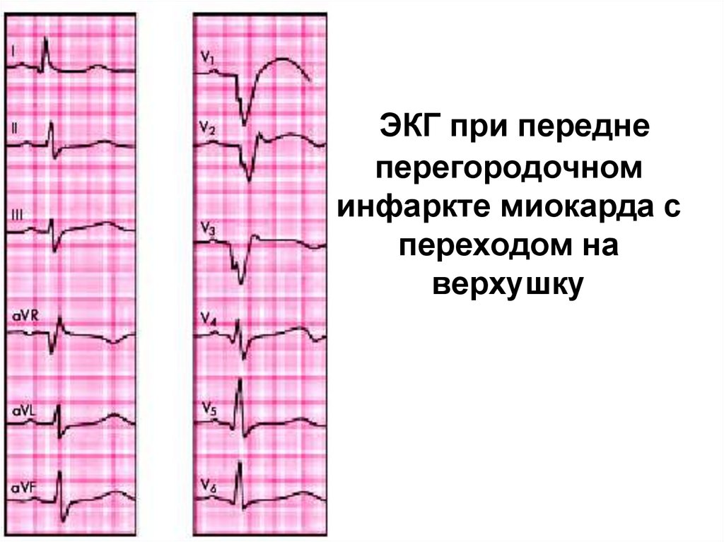 ЭКГ при передне перегородочном инфаркте миокарда с переходом на верхушку