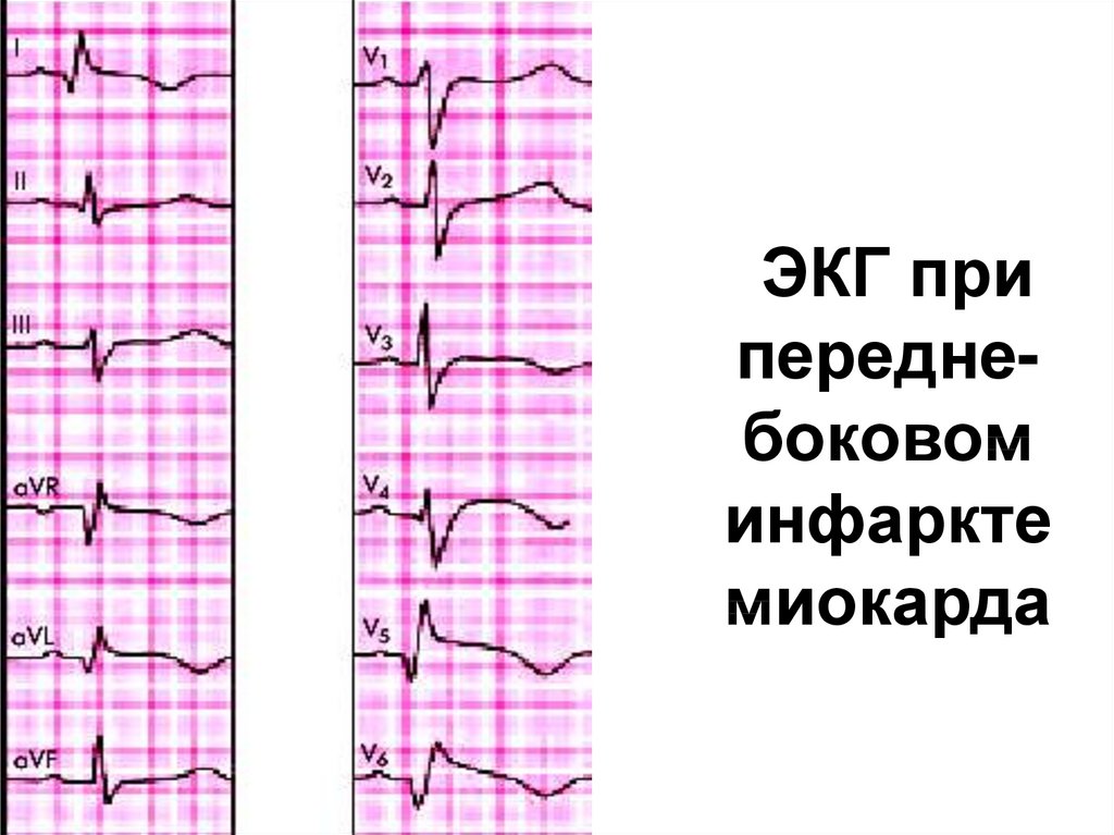 ЭКГ при передне- боковом инфаркте миокарда
