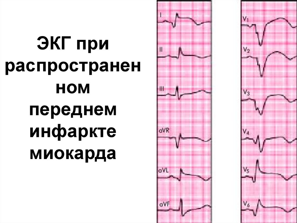 ЭКГ при распространенном переднем инфаркте миокарда