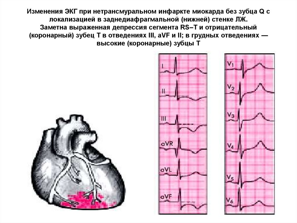 Изменения миокарда на экг. ЭКГ при заднедиафрагмальном Нижнем инфаркте миокарда. ЭКГ при нетрансмурального инфаркта миокарда. Инфаркт заднедиафрагмальной стенки отведения. ЭКГ при инфаркте без зубца q.