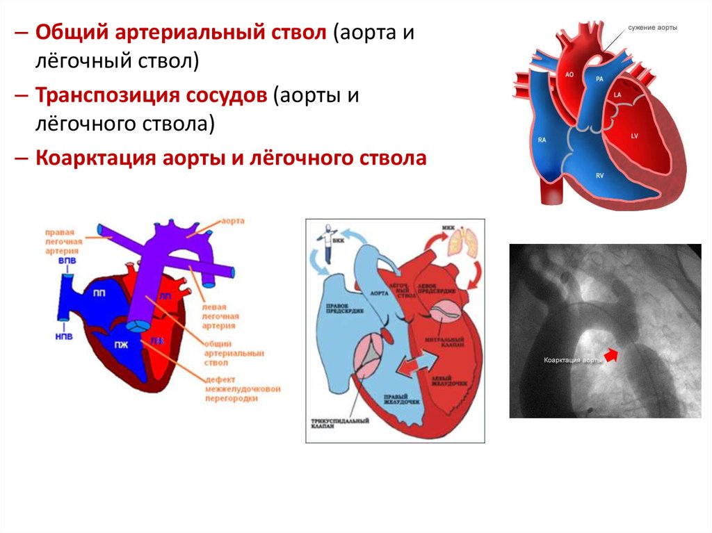 Легочный ствол картинка