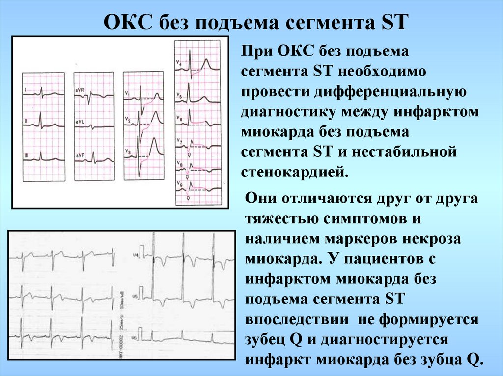 Без подъема st на экг. Окс без подъема сегмента ст ЭКГ. ЭКГ критерии Окс без подъема St. ЭКГ инфаркт миокарда с подъемом St. ЭКГ инфаркт миокарда без подъема St.