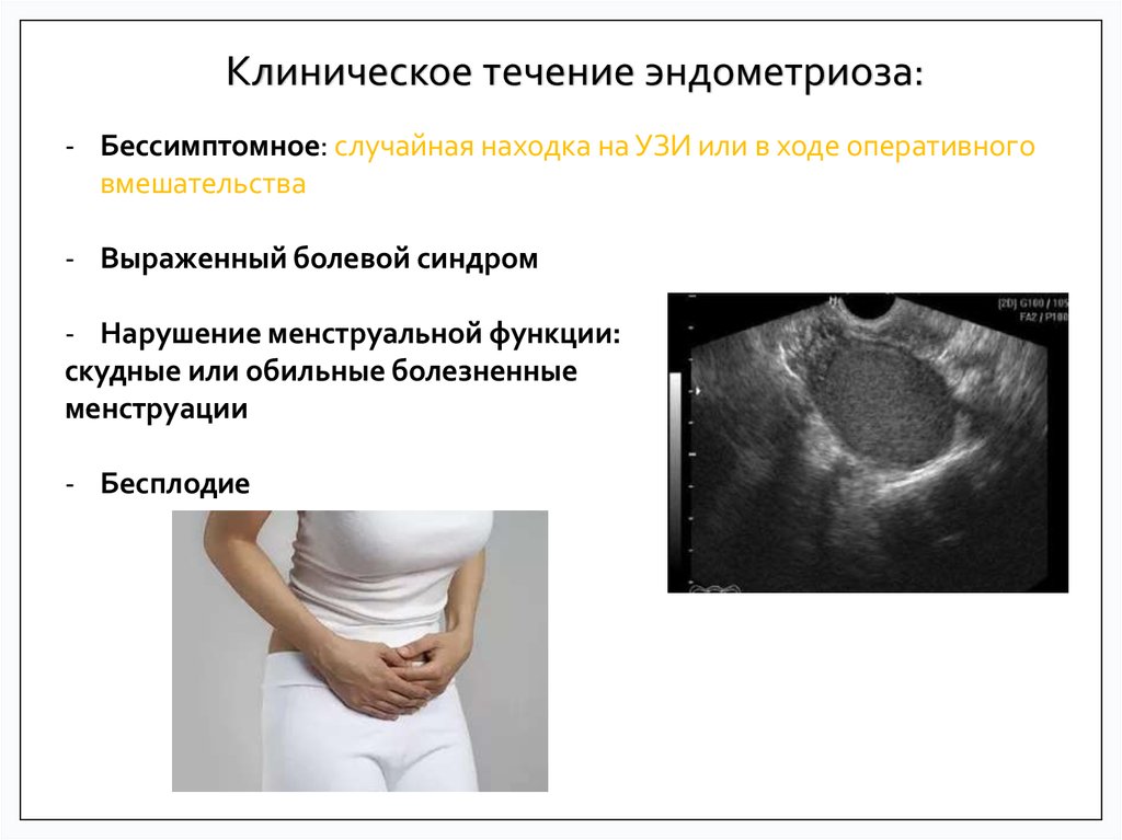 Эндометриоз видно на узи. Эндометриоидная киста яичника на УЗИ. Эндометриозная киста яичника на УЗИ. Эндометриоз яичников на УЗИ. Киста правого яичника эндометриоидная на УЗИ.