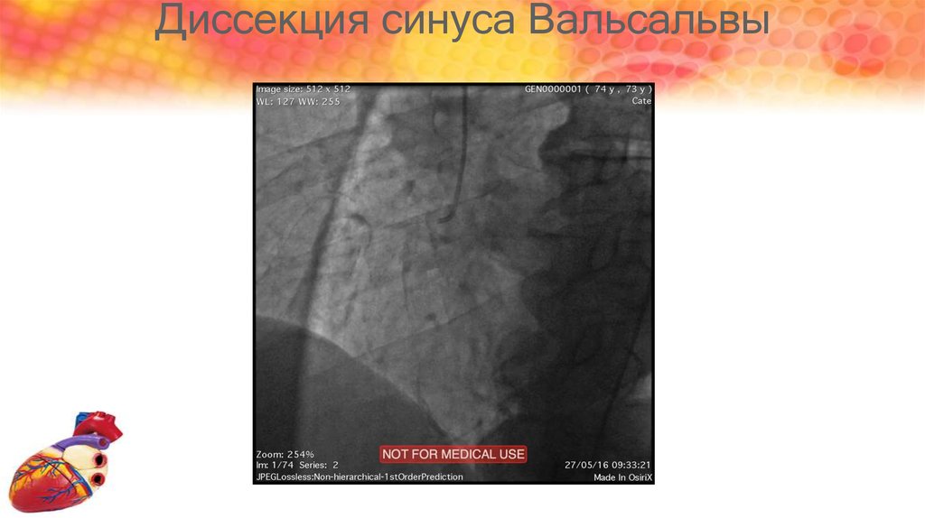 Синус вальсальвы это. Чрескожное коронарное вмешательство ЧКВ. Аневризма синуса Вальсальвы. Синусы Вальсальвы норма.