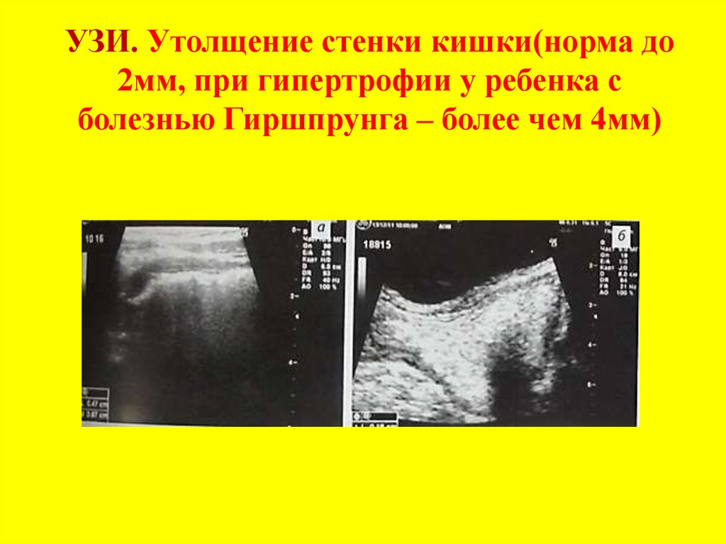 Утолщены стенки. Утолщения стенки Толстого кишечника УЗИ. Синдром Гиршпрунга на УЗИ. Толщина стенки кишечника в норме УЗИ. Утолщение стенки кишечника на УЗИ.