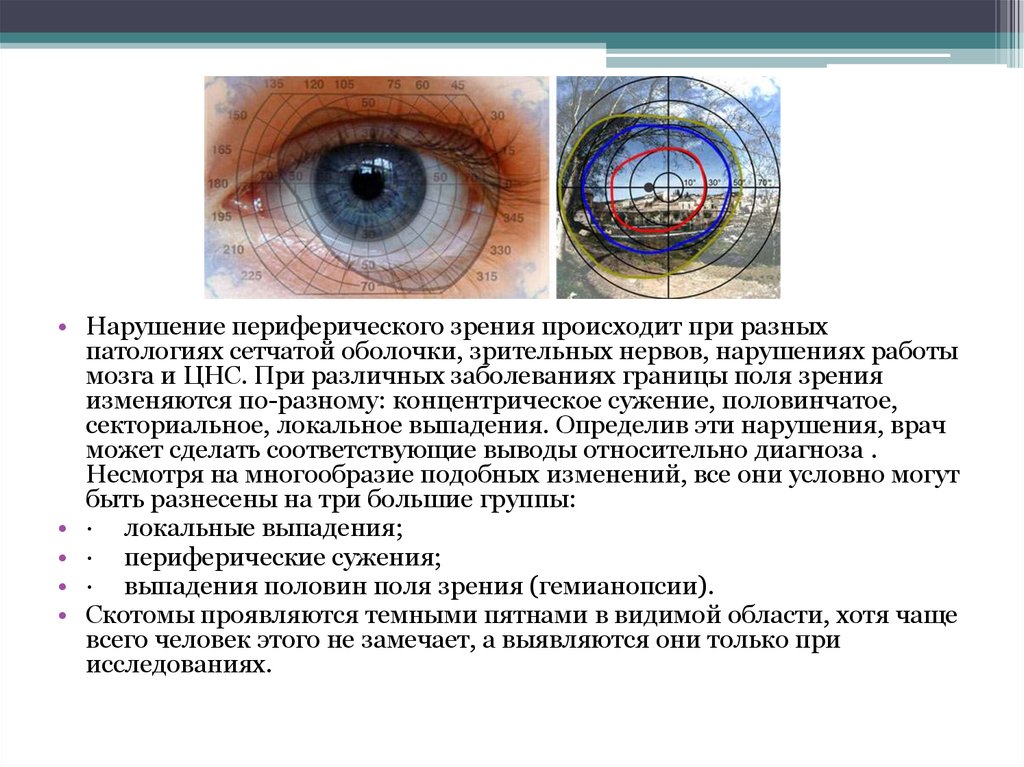 Периферическое центральное нарушение. Нарушение периферического зрения. Нарушения зрения центральные и периферические. Обследование периферического зрения. Оценка периферического зрения.