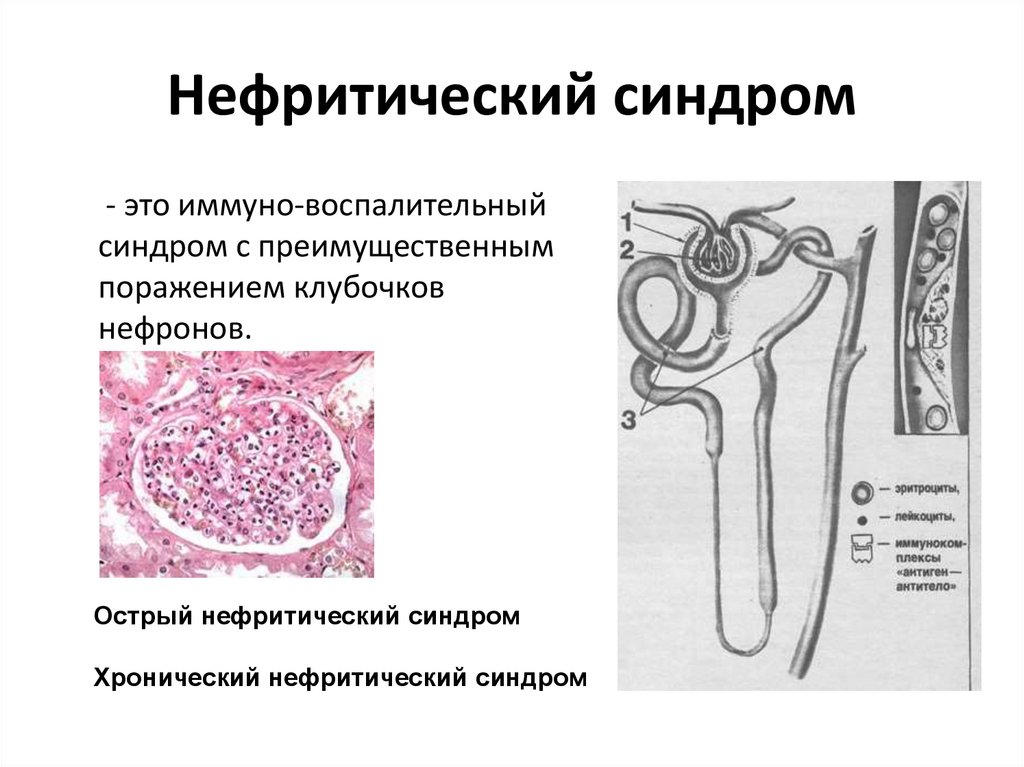 Энцефалопатия на фоне почечной недостаточности