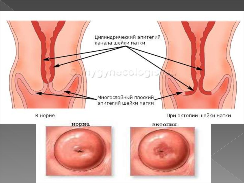 Эктопия это. Эрозированный эктропион. Эктопия цилиндрического эпителия шейки матки. Цилиндрическая форма шейки матки. Коническая форма шейки матки.