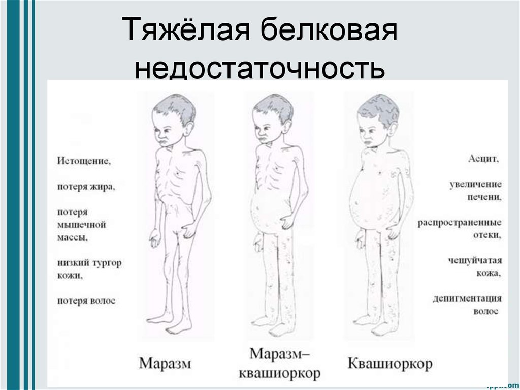 Заболевание белок. Заболевания при недостатке белка. Белковая недостаточность заболевания. Белковая недостаточность последствия. Белковая недостаточность у детей симптомы.