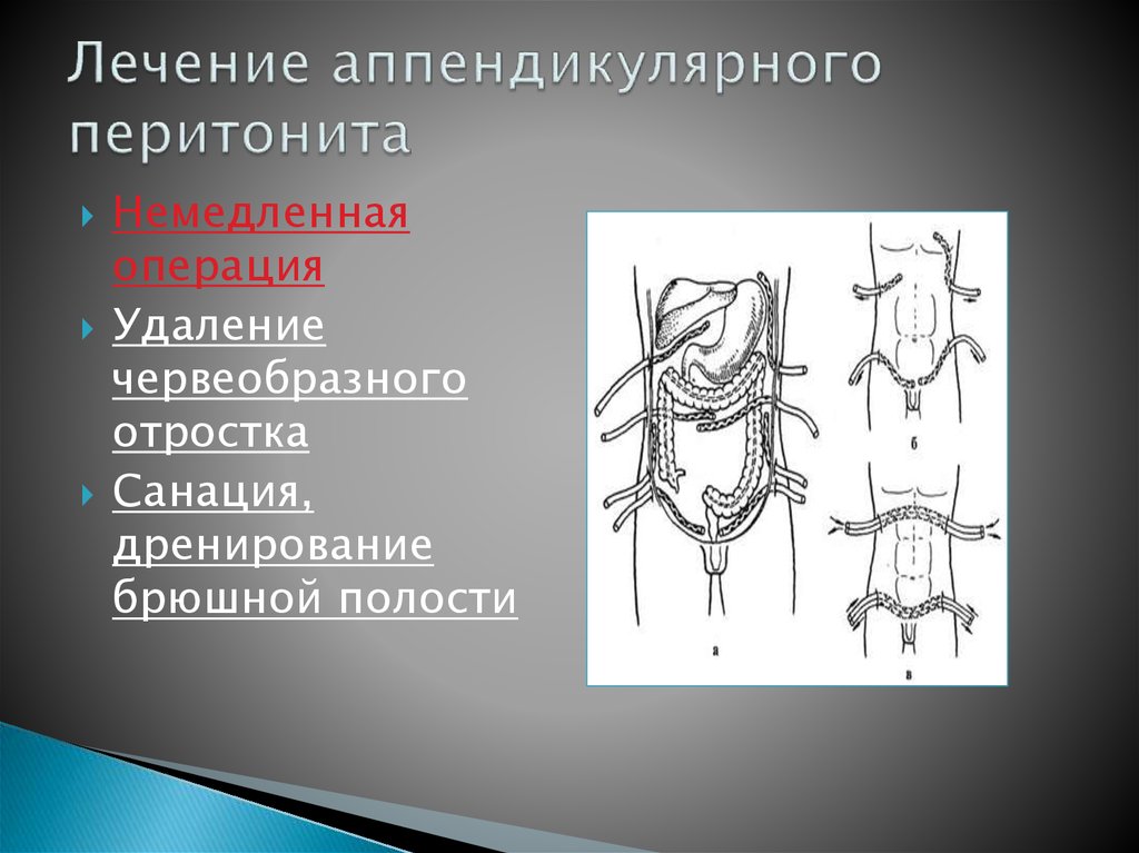 Схема дренирования брюшной полости при перитоните