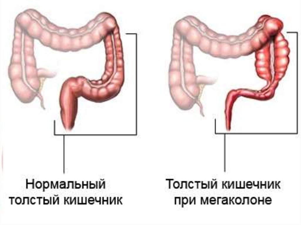 Долихосигма кишечника. Толстая кишка болезнь Гиршпрунга. Расширение Толстого кишечника мегаколон у детей. Мегаколон болезнь Гиршпрунга. Классификация запоров мегаколон.