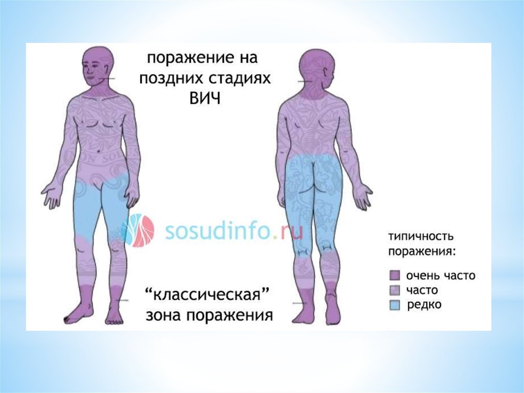 Поражения тела. Локализованная саркома Капоши.