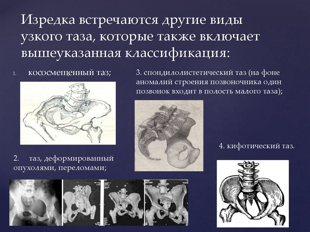 Аномалии таза презентация