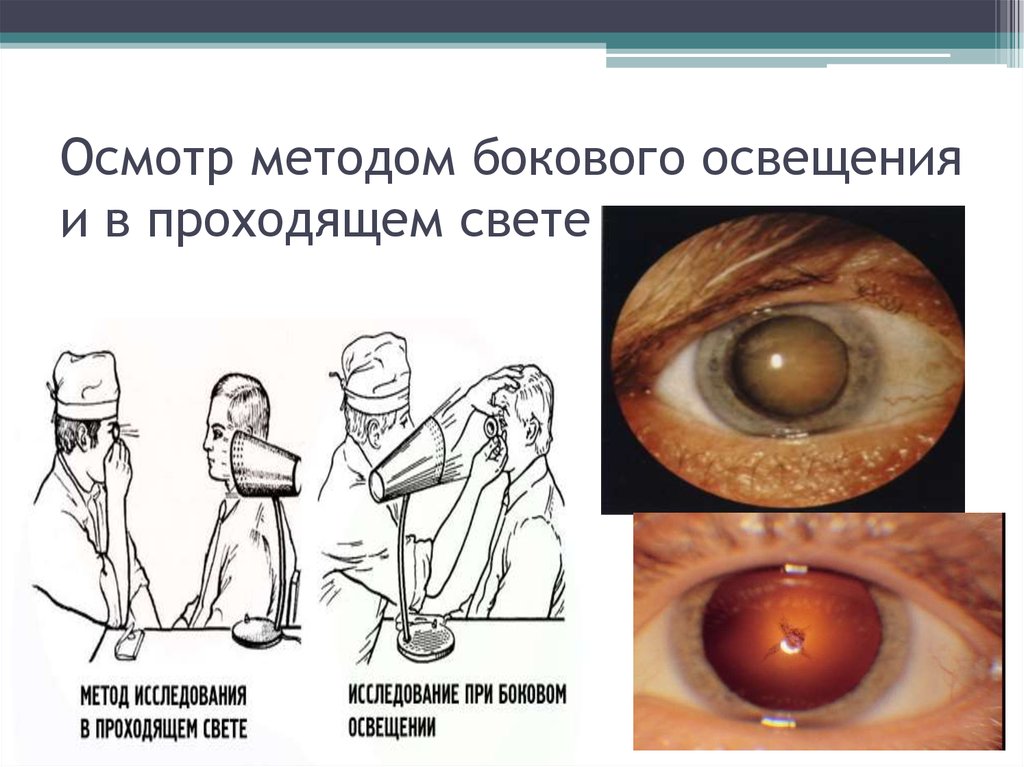 Пройди свет. Осмотр глаза методом бокового освещения. Исследование глаза методом бокового освещения. Исследование при боковом фокальном освещении. Метод бокового освещения офтальмология.