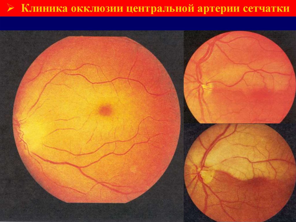 Клиника глаза сетчатки. Острая непроходимость сосудов сетчатки. Острая непроходимость цас. Тромбоз ветви центральной артерии сетчатки.
