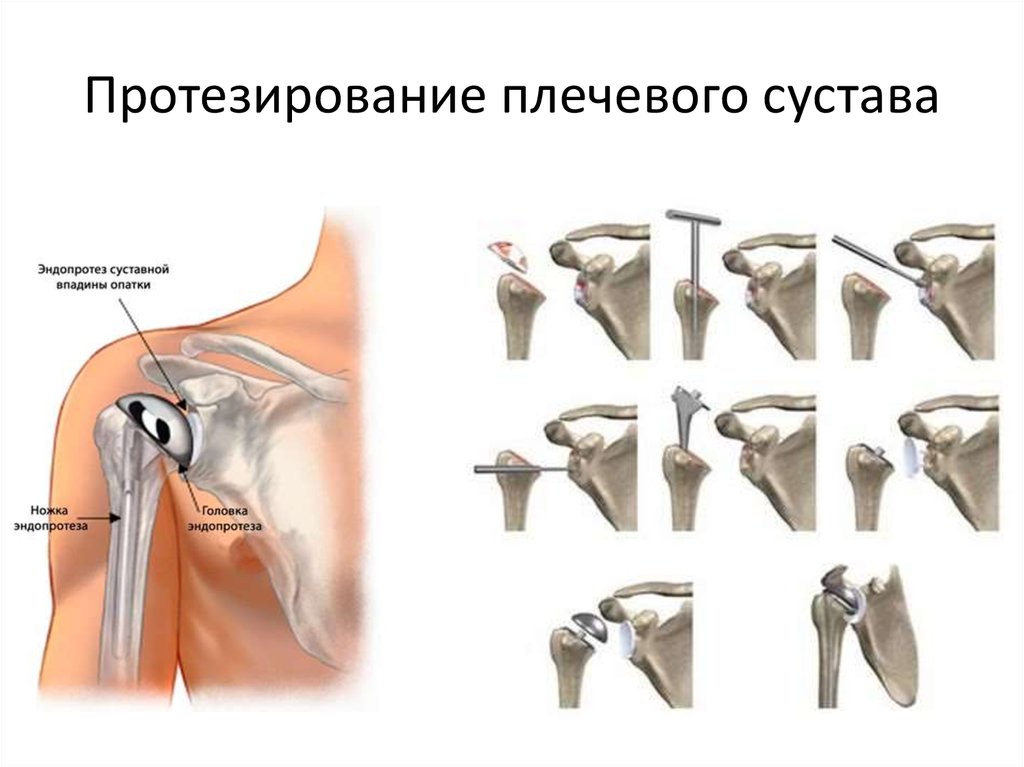 Операция по замене плечевого сустава. Эндопротез плечевого сустава. Плечевой сустав с захватом плечевой кости. Имплант плечевого сустава. Реверсивный протез плечевого сустава.