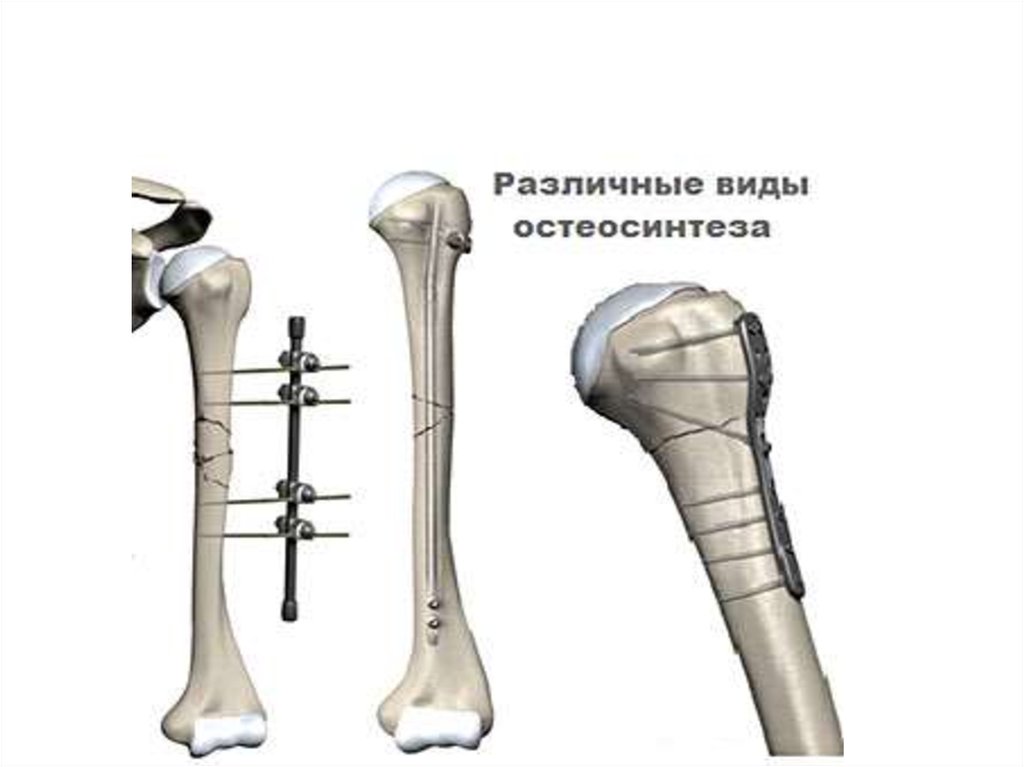 Операция после перелома плеча. Остеосинтез диафиза плечевой кости. Перелом плечевой кости экстрамедуллярный остеосинтез. Перелом диафиза плечевой кости остеосинтез. Перелом хирургической шейки остеосинтез плечевой.