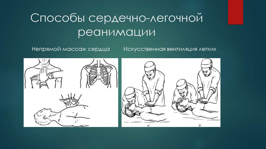 Тесты сердечно легочной реанимации