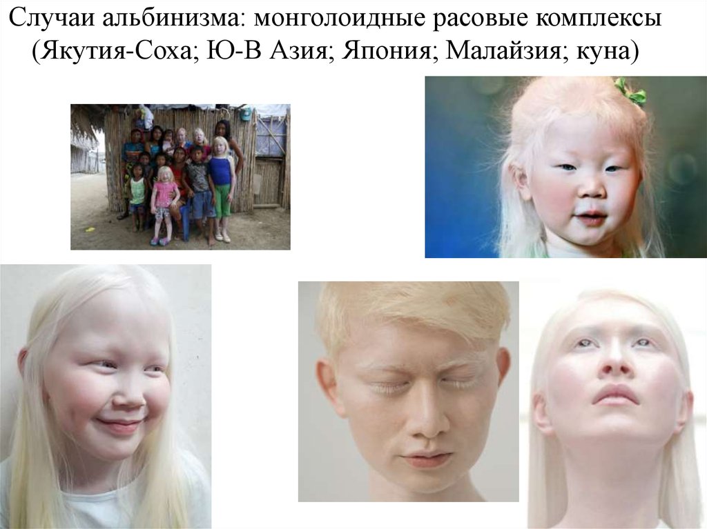 Альбинизмом страдают. Расовый комплекс. Монголоидный расизм. Монголоидный Тип волос. Монголоидные черты лица.