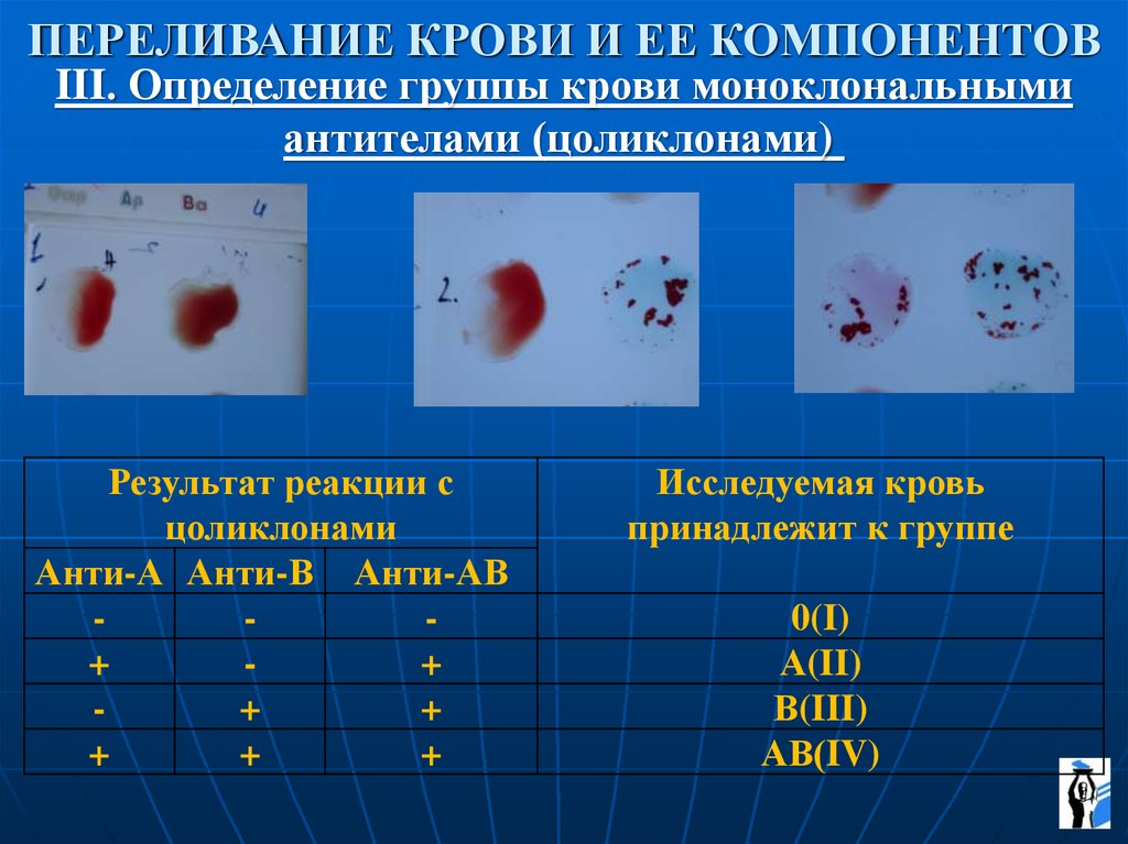 Результаты переливания крови. Цоликлоны для определения группы крови. Определение группы крови цоликлонами. Определение групп крови моноклональными антителами. Группы крови переливание.