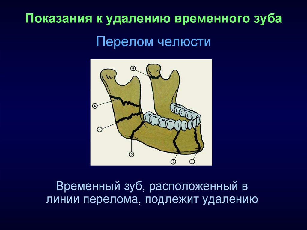 Мудрости на нижней челюсти. Зуб находящийся в линии перелома челюсти. Зуб, находящийся в линии перелома. Перелом челюсти зуб мудрости.