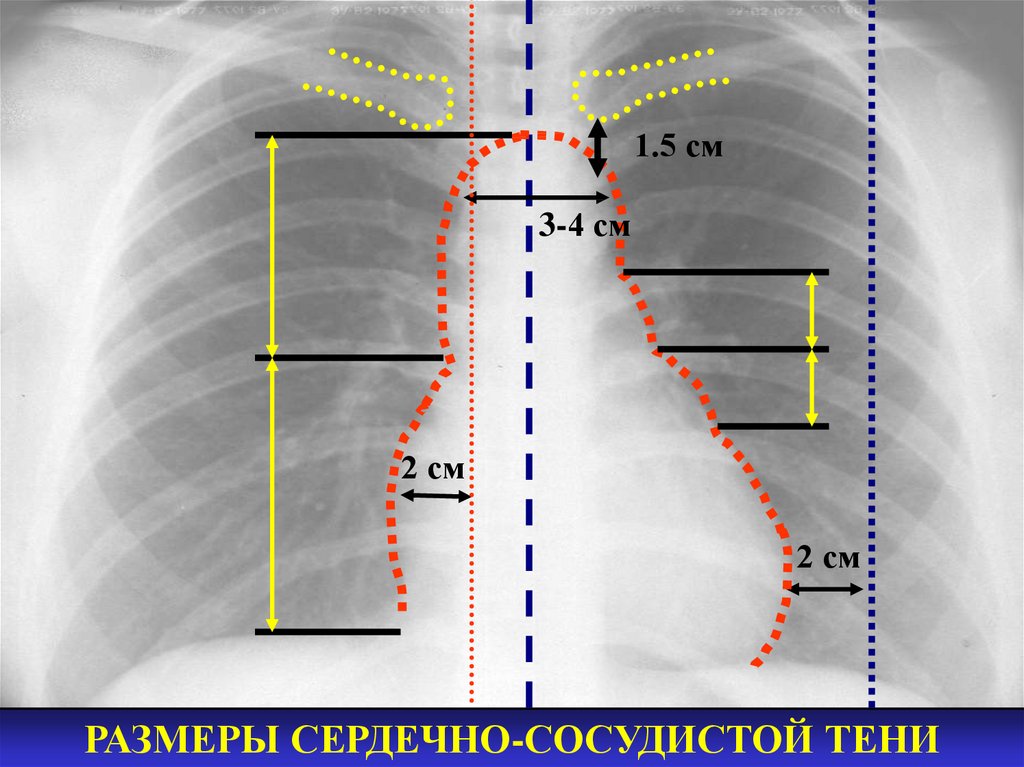 Границы расширены влево. Лучевая анатомия (рентгеновское изображение) сердца в норме. Тень сердца на рентгенограмме в норме. Дуги сердца на рентгенограмме. Ркнигкн анатомия сердца.