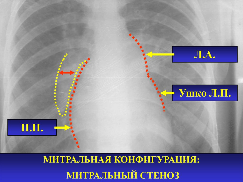 Митральное сердце. Митральная конфигурация рентген. Митральная конфигурация сердца рентген. Митральный стеноз рентген. Митральная конфигурация сердца на рентгенограмме.