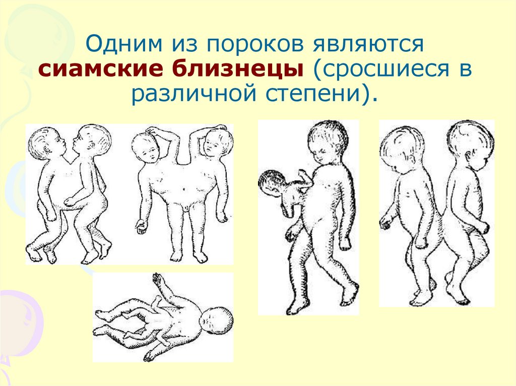 Сиамские близнецы презентация