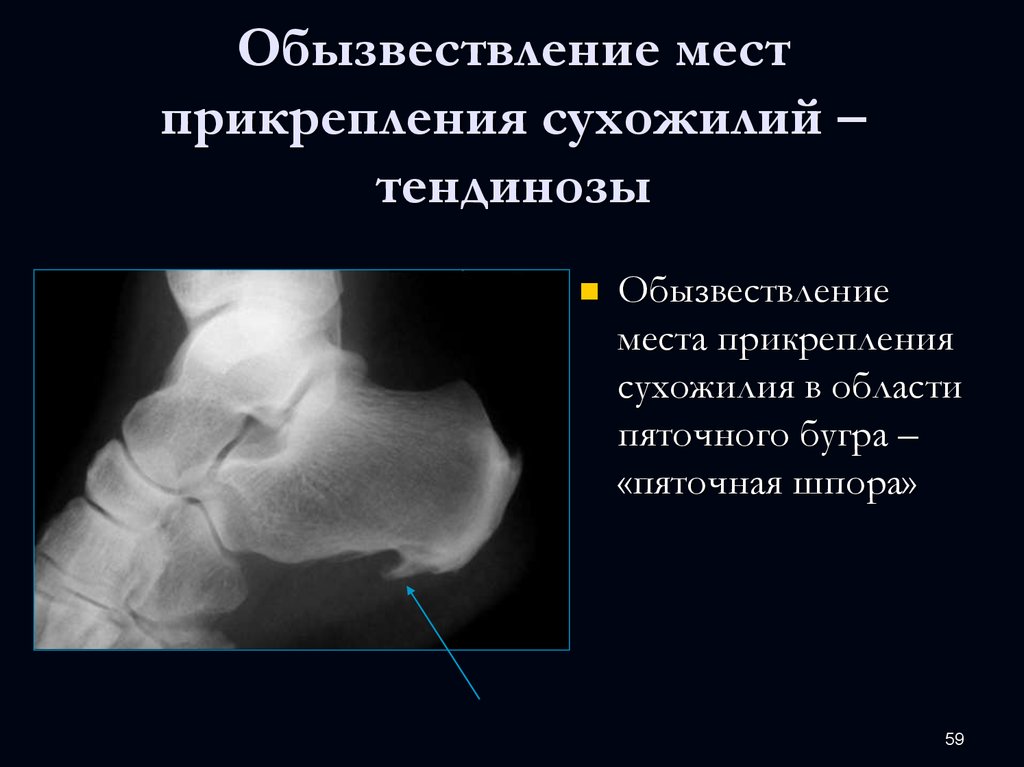 Обызвествление мышцы бедра