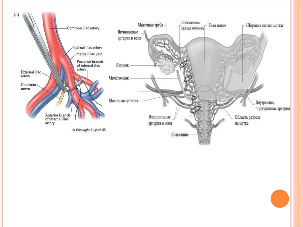 Перевязка маточных сосудов. Перевязка внутренней подвздошной артерии. Перевязка маточных артерий. Перевязка маточных труб. Перевязывание маточных труб у женщин.