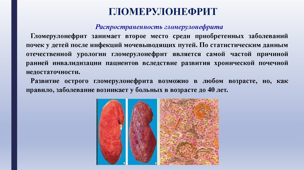 Гломерулонефрит у детей