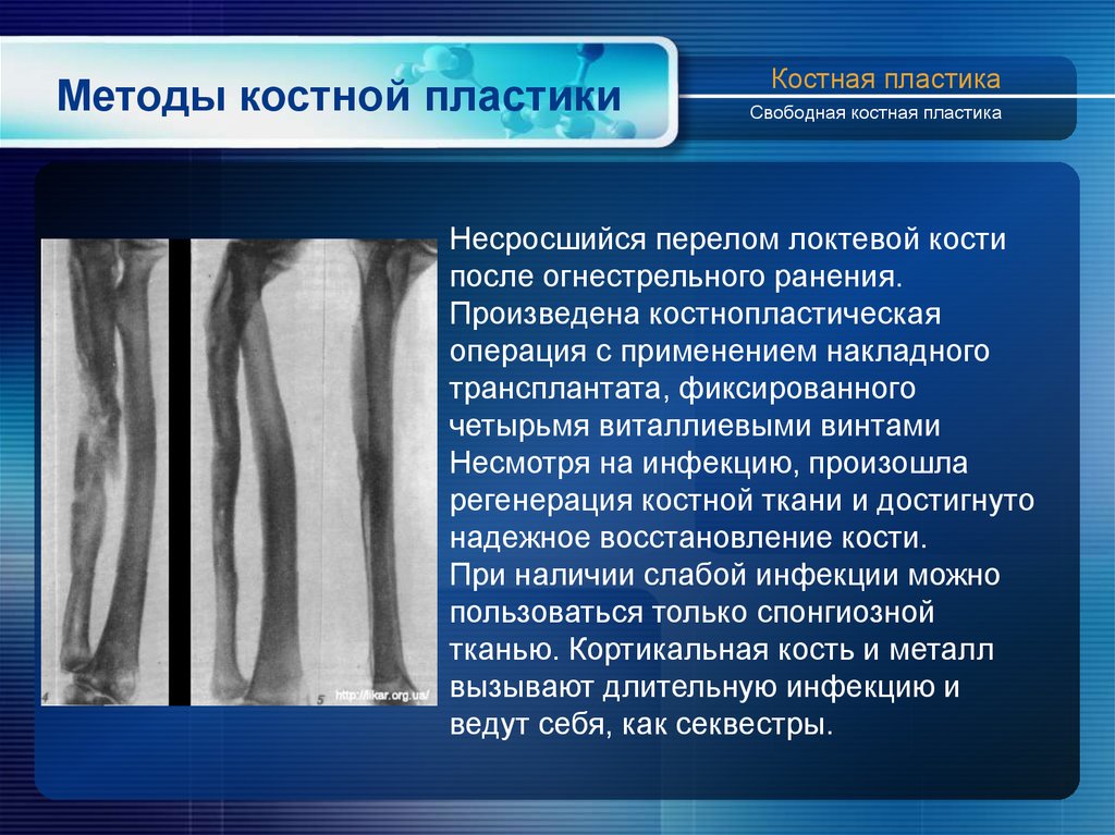 Регенерация костной ткани травматология презентация