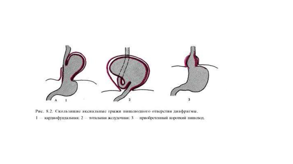 Степени грыжи пищевода. Аксиальная скользящая ГПОД. Скользящая грыжа пищевода. Скользящая грыжа пищеводного отверстия диафрагмы. Грыжа пищеводного отверстия диафрагмы картинки.