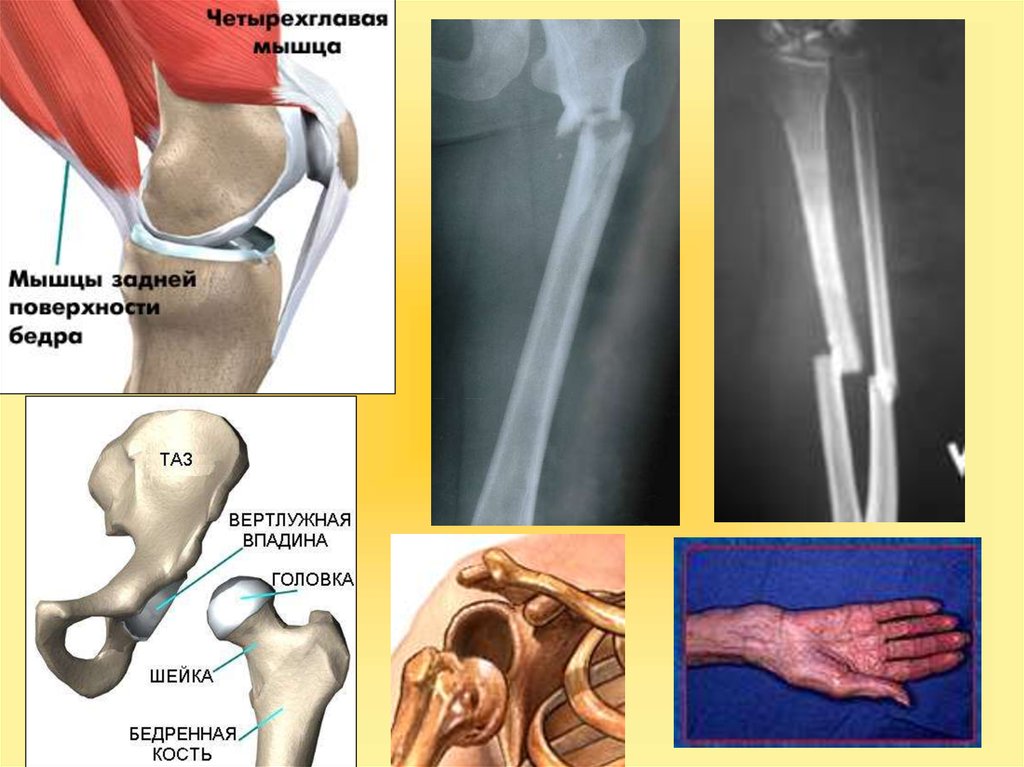 Переломы вывихи презентация