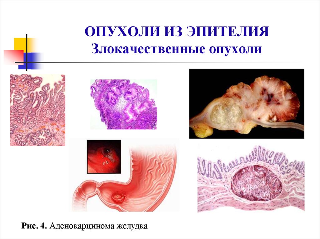 Опухоли общая хирургия презентация