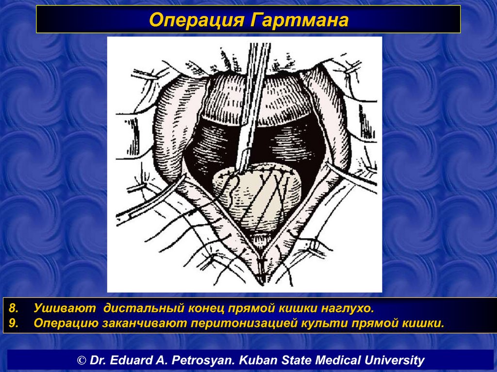 Операция лахея схема