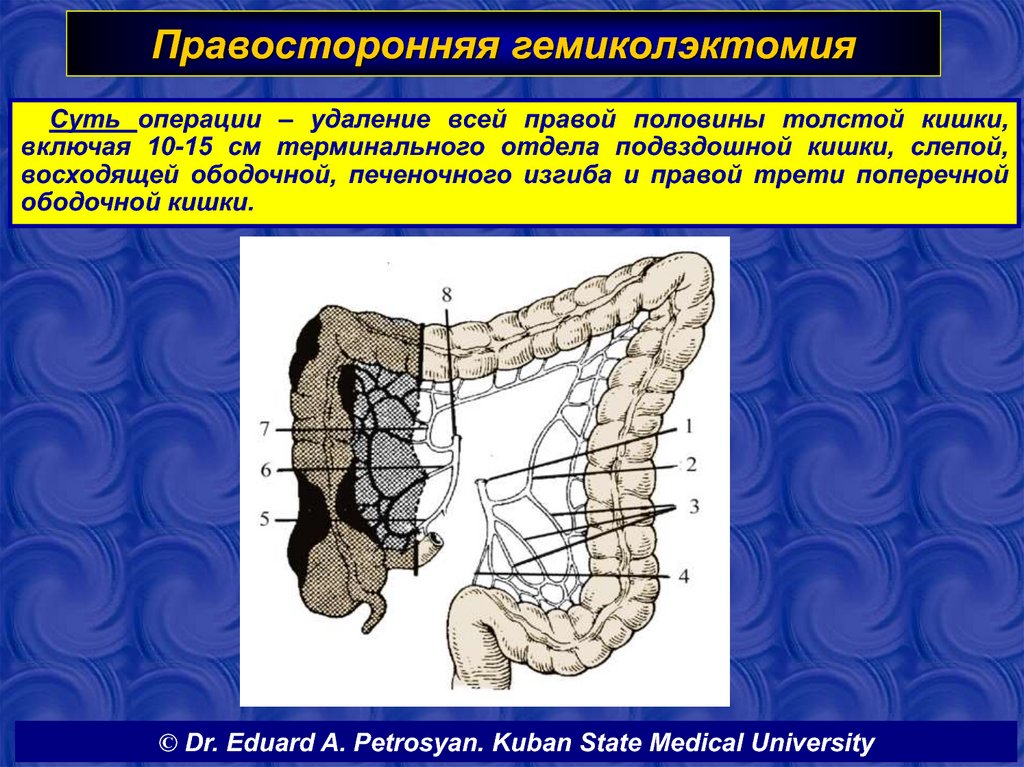 Удаление толстой кишки. Гемиколэктомия ободочной кишки. Гемиколэктомия слепой кишки правосторонняя. Правосторонняя гемиколонэкотмия. Правосторонняя гемиколэктомия схема.
