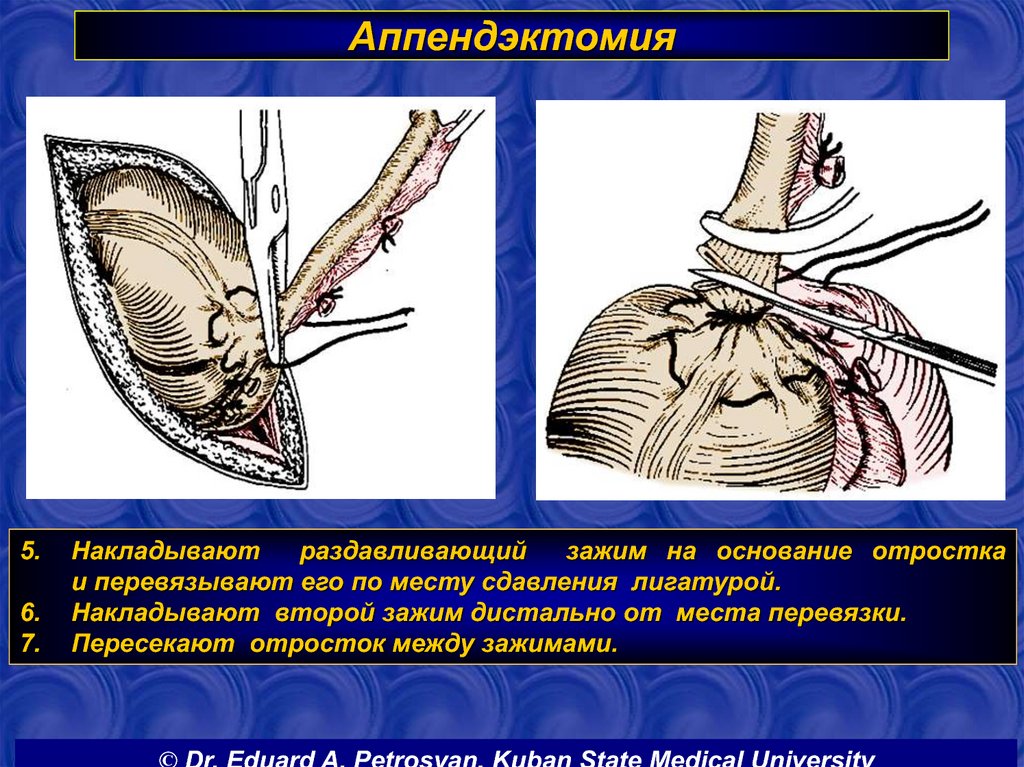 Основание операции. Этапы операции аппендэктомии. Классическая аппендэктомия этапы.