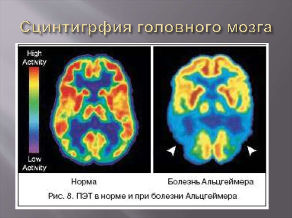 Деменция на мрт. Позитронно-эмиссионная томография мозга. Позитронно эмиссионная томография болезнь Альцгеймера. ПЭТ- позитронно-эмиссионная томография головы. ПЭТ кт опухоли головного мозга.