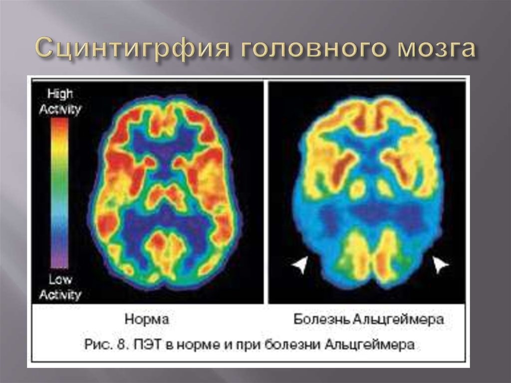 Норма мозга. Позитронно-эмиссионная томография мозга. Позитронно эмиссионная томография болезнь Альцгеймера. Альцгеймера болезнь ПЭТ кт. Кт и мрт при болезни Альцгеймера.