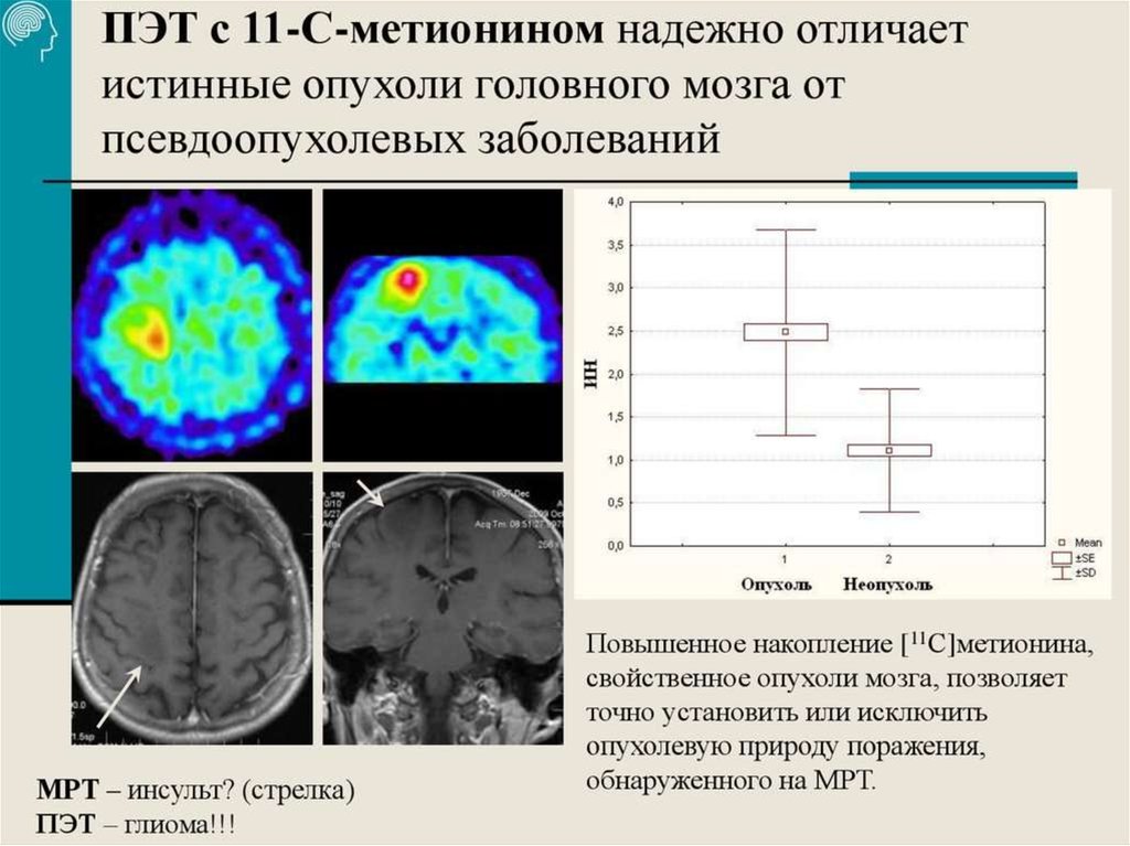Объемное образование головного мозга код. ПЭТ кт головного мозга. ПЭТ кт опухоли головного мозга. Позитронно-эмиссионная томограмма головного мозга. Позитронно-эмиссионная томография опухоли.