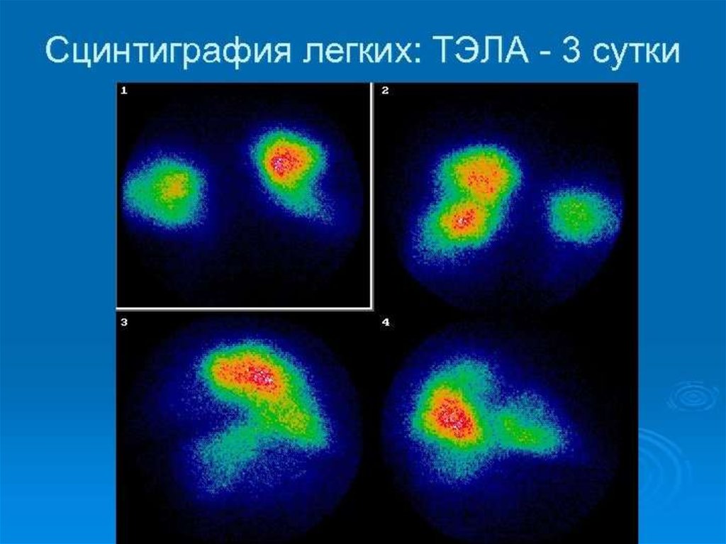 Презентация сцинтиграфия миокарда