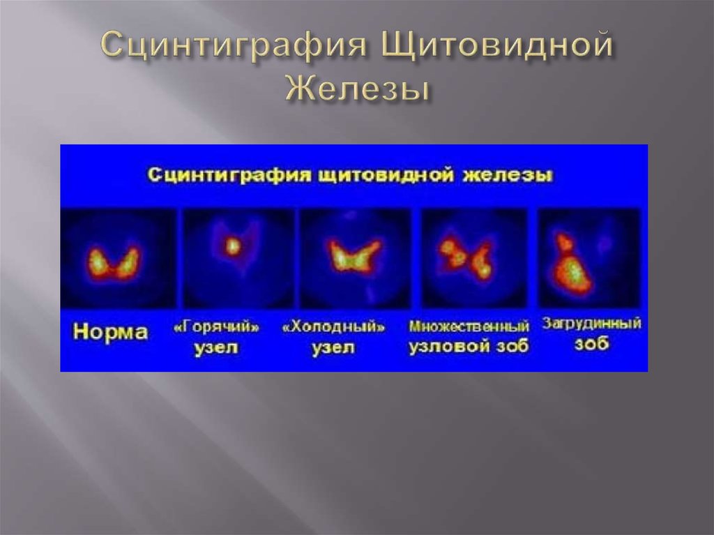 Сцинтиграфия Щитовидной Железы