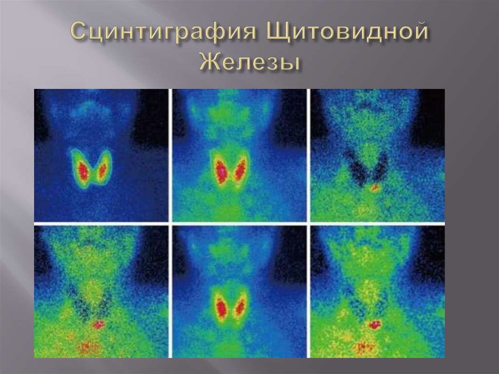 Сцинтиграфия Щитовидной Железы