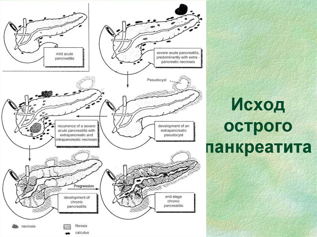 Острый панкреатит карта смп